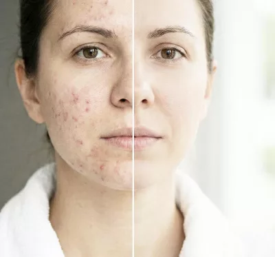 Acné y Piel Joven