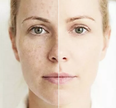 Anti manchas, acné o cicatrices