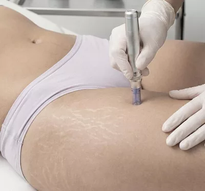 Tratamiento de Estrías